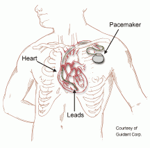 pacemaker1
