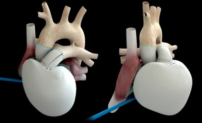 carmat_artificialheart