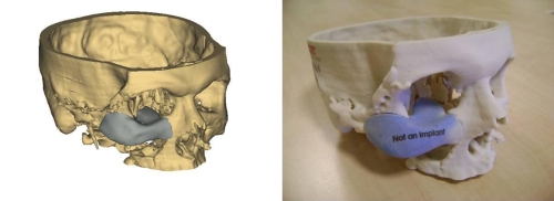 3d-printed-cheek
