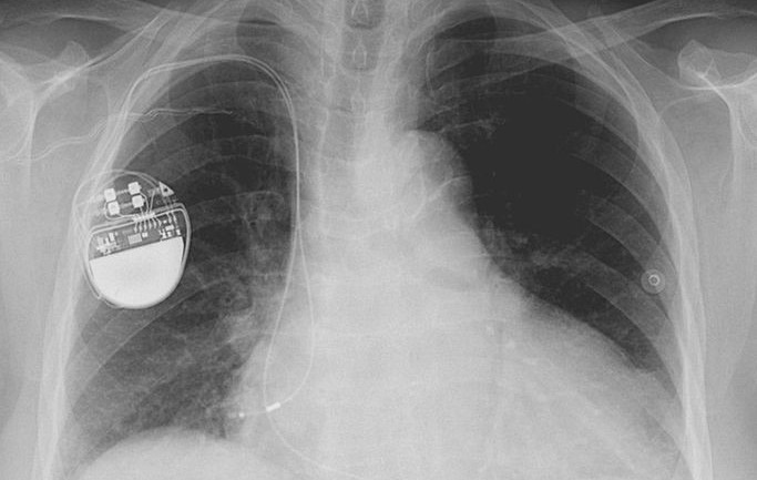 The Future of Medicine: Muscle-Powered Pacemaker – Stories by Williams