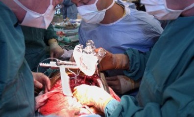 artificial-heart-abiocor-implanting