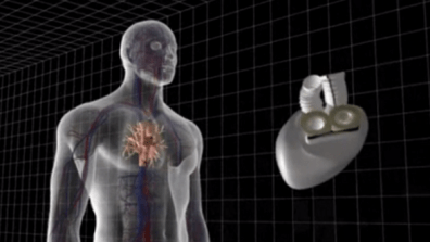 carmat-artificial-heart